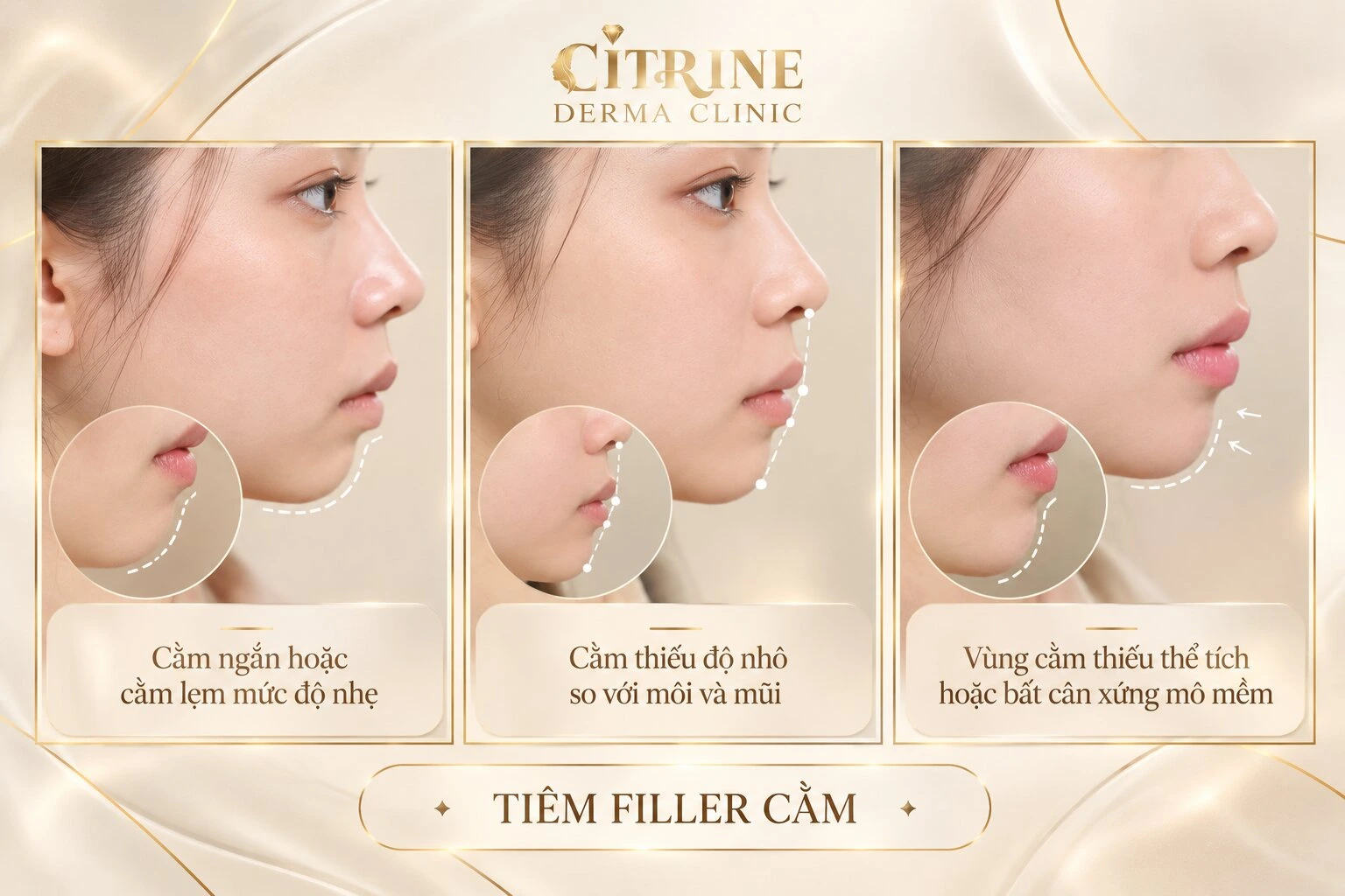 Tiêm filler cằm